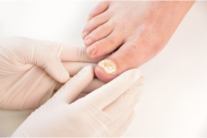 Getting Rid of Stubborn Nail Fungus: Effective Treatments and Prevention Tips 
